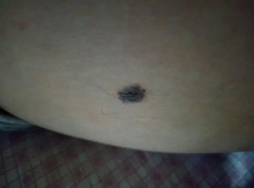 请问这颗黑痣正常嘛?上面有长毛!