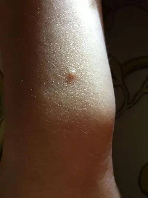 四岁宝宝小腿上,手臂上一共有三个类似的水泡