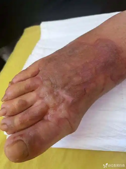 老年人足部烫伤在家处理效果不错