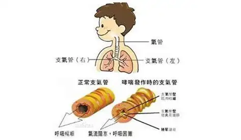 小儿支气管肺炎是怎么回事