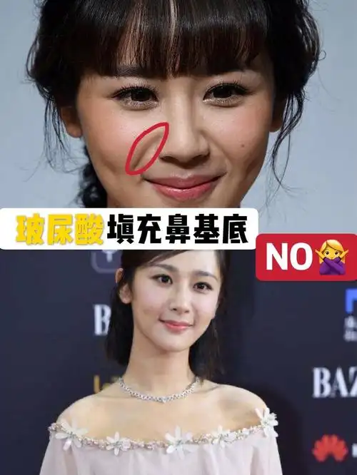 韩国出差的时候打的,感觉效果还行的,皮肤水灵了些,填充的效果不错的