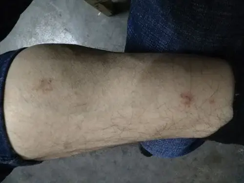 如图,腿上的是湿疹吗,那3样药能治吗?