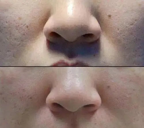 毛孔粗大怎么办?