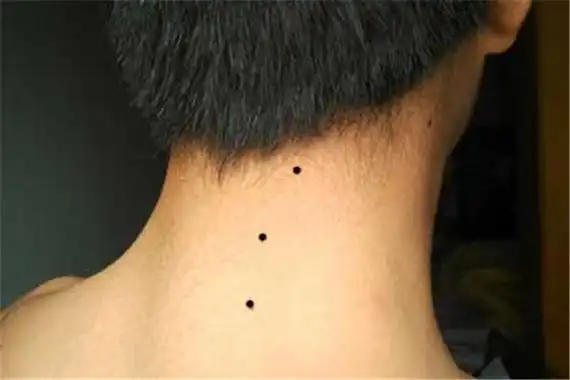 千年一遇的痣长什么样被称为三星痣共同构成三角形