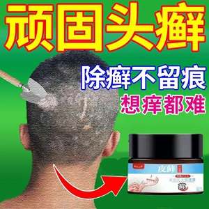 头癣药膏银屑癣治顽固性皮癣毛囊炎头部专用皮痒头皮藓真菌感染