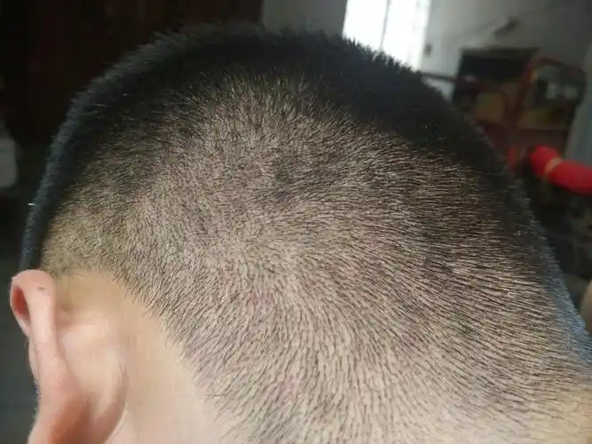 头上起的这是啥?头皮发红