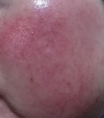 从小就有的红血丝很严重的不要担心