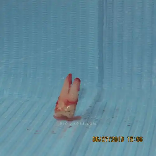 上颌第一双尖牙3牙根