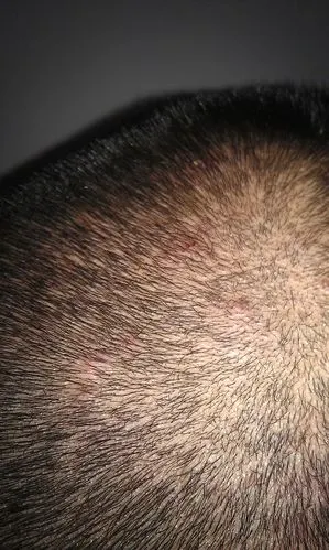 头皮长出大量红色脓包