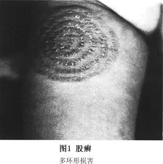 股癣是好发于股部的皮肤病,有时还可累及会阴,阴阜部,肛周,臀部,阴囊