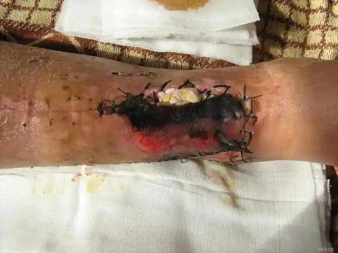 胫腓骨远端开放性粉碎性骨折术后皮肤坏死内固定外露