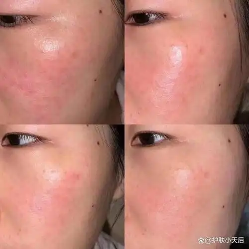 护肤品的敏感肌肤护理:如何缓解敏感和过敏问题?