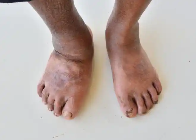 糖尿病出现腿黑可能是三个原因请要多加重视