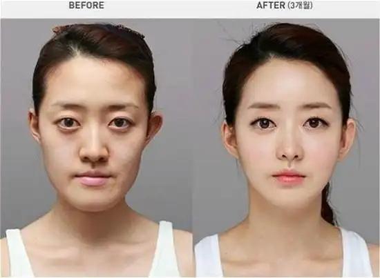 韩国推整容认证书 因旅客整容前后差异大