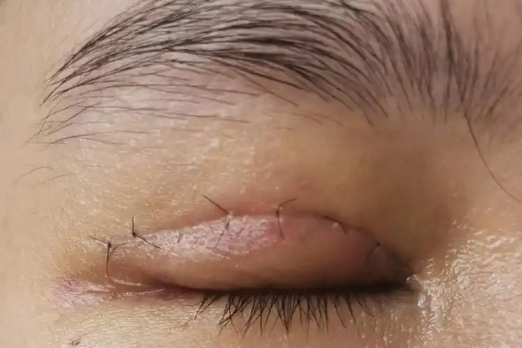 术后一只涂了医院给的药膏,今天突然发现线结处有白