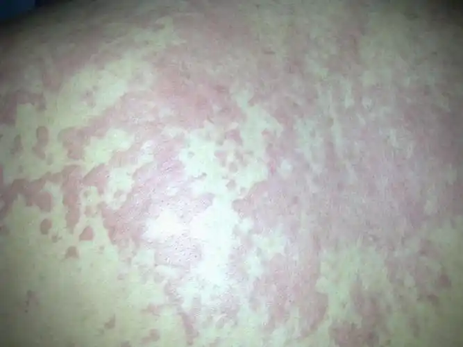 都把血. 15 2013-08-20 怎样治热疙瘩?身上有小红点特别痒又不敢挠.