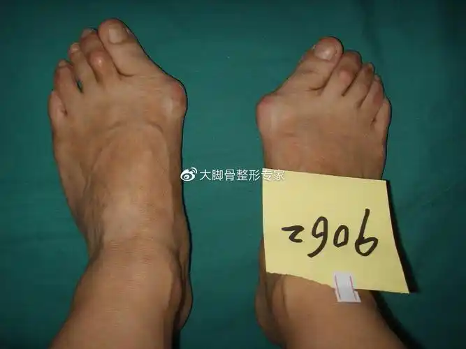 哪些办法治疗大脚骨凸起安全有效?