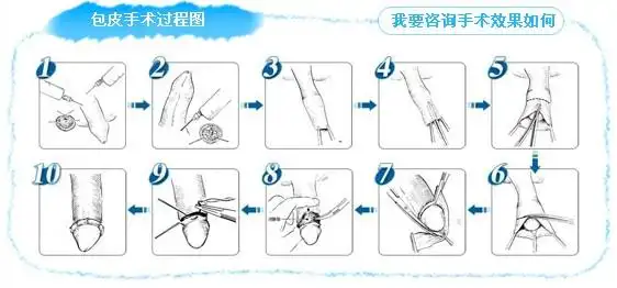 包皮手术——自然美观,微创无痛
