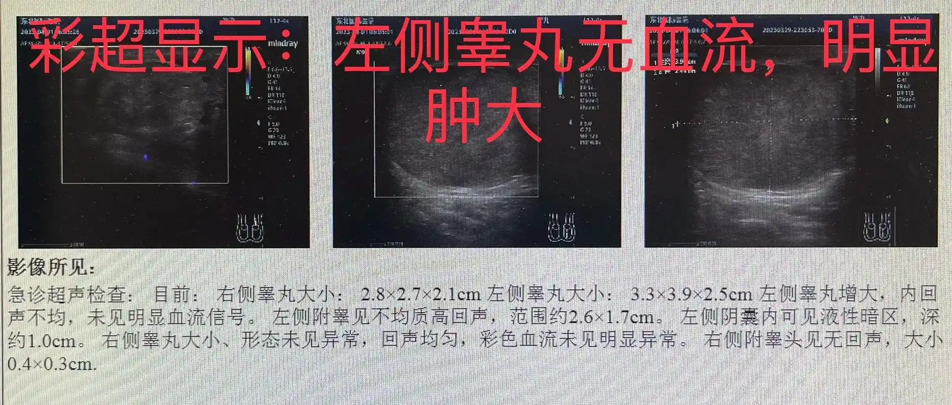 清晨急诊手术:左睾丸扭转.  患者资料:男性16岁 - 抖音