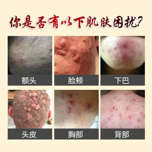 【京东大药房直发】治头皮毛囊炎药膏脂溢性皮炎头部胸背部脓包痤疮