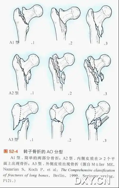 evans分型 Ⅰ型 无移位