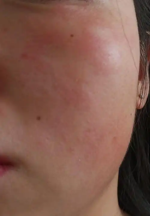 脸经常起小碎皮,还很疼,摸起来很粗糙_新氧-专业医美服务平台