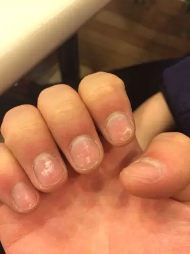 手指甲上面有白色的点点状!请问是缺什么营养吗?