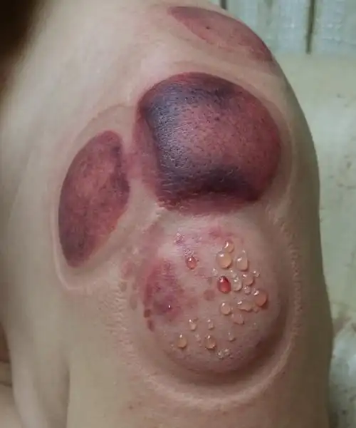 拔罐治肩周炎水去血来