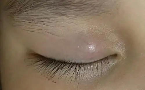 眼睑常见疾病霰粒肿