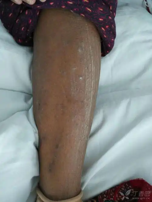 透析病人,皮肤瘙痒,求解决方法