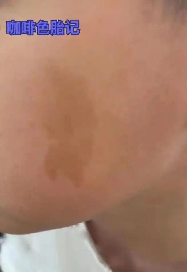 上热门 #问题性皮肤管理 #袪斑 八岁小孩咖啡色胎记,四 - 抖音