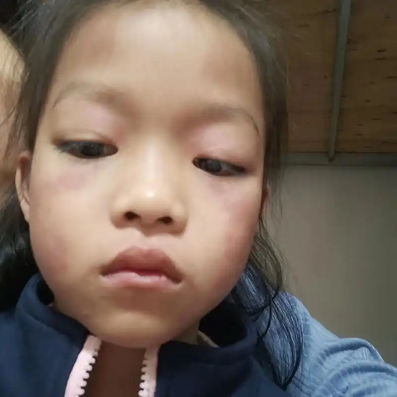 一大早起来看到脸红红的全身都是皮肤过敏了