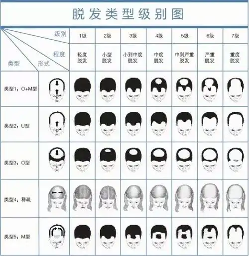 常规的脱发也是分很多种类的,除了遗传性脱发(也叫脂溢性脱发)以外