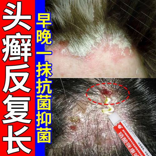 头皮癣银屑病专用药膏 头皮屑治疗去屑药 头皮痒脂溢性皮炎毛囊炎头部