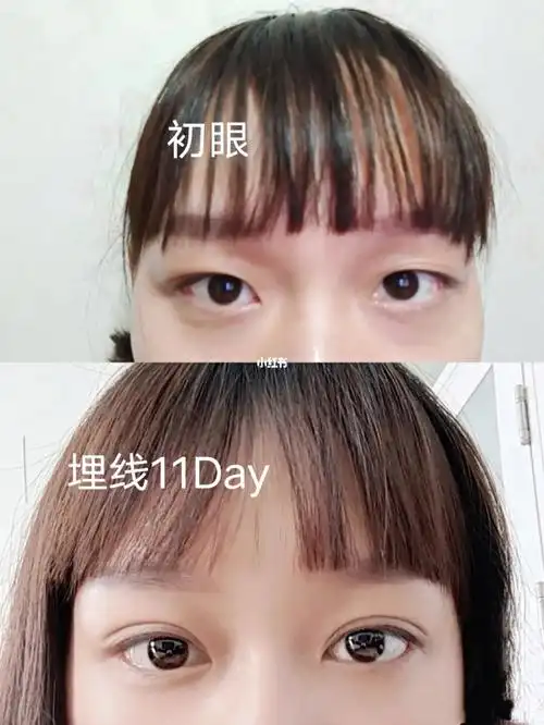 埋线双眼皮前后对比