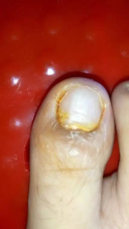 脚趾甲根部发白,按下去软软的,根部皮肤有点肿,后来擦了碘酊后开始变