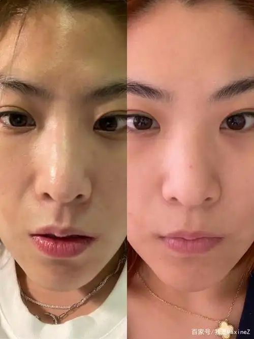 面部改善前后对比图