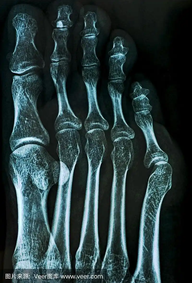 脚趾骨的x光片