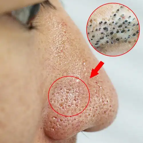 抖音同款【2018皮肤救星】毛孔克星 快跟大毛孔说拜拜 第二瓶半价