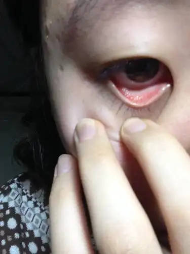 下眼睑接近睫毛处发红.怎么回事啊!我带了一周隐形眼镜,刚