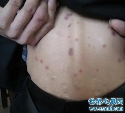 快看看这些梅毒图片 这种性病没有症状长期潜伏你得知道 !