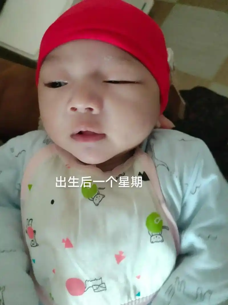 先天性眼睑下垂宝宝的两年.