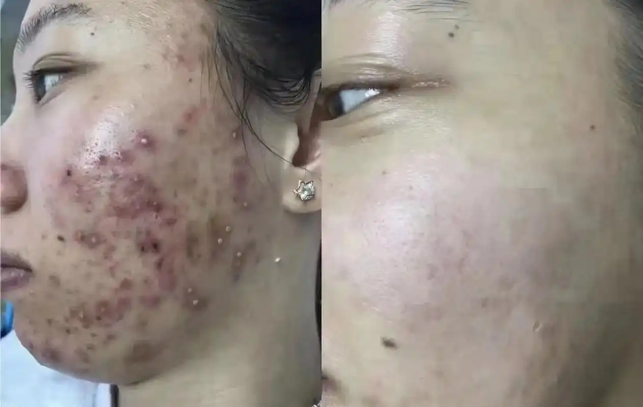 有这些皮肤困扰的请来找我