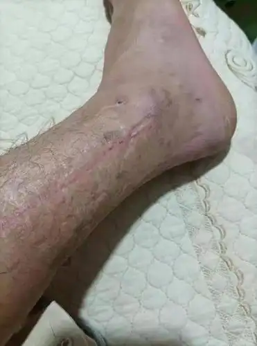 医院故事工地受伤险截肢9个诊断多次手术保腿成功