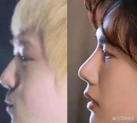 呈现出硅胶般的触感.鼻翼两侧呈现加宽的状态,鼻头则变得更加翘挺.