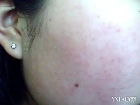 脸上皮肤过敏症状图片脸上皮肤过敏症状的原因