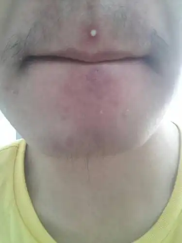 三角区长得什么东西?是感染吗?应该怎么处理?