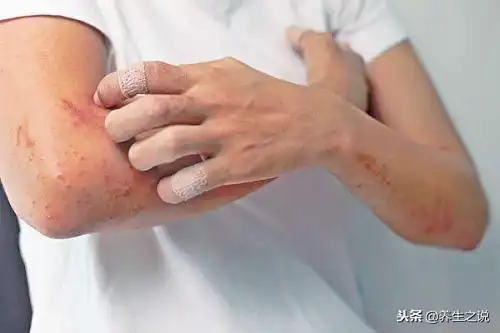 6,皮肤瘙痒,也是尿毒症者常见的症状之一.