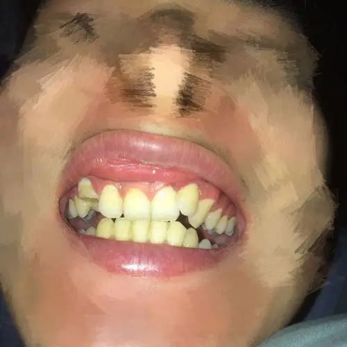 如图,左边的虎牙是4年前摔断了半个,然后牙神经拔掉了,右边的门牙是小