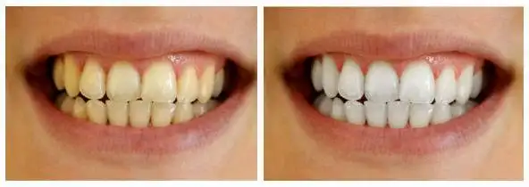 病态的牙齿发黄有什么因素?